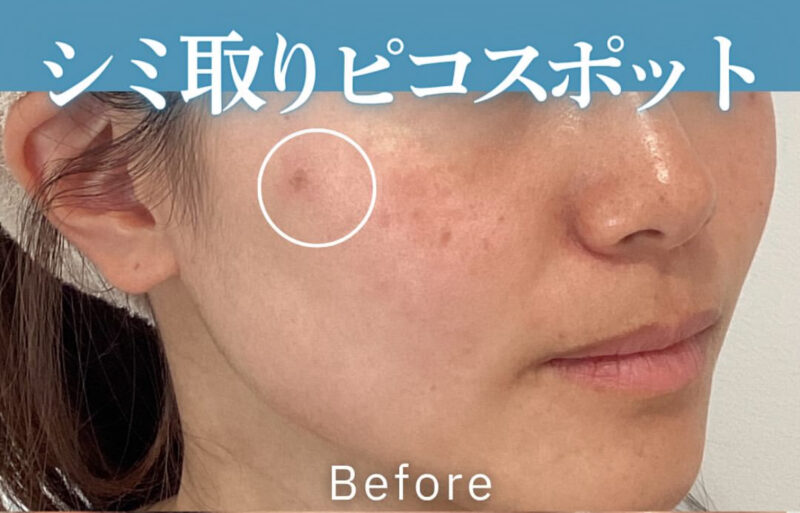 30代女性：ピコスポット