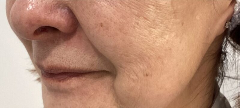 60代女性：肌のたるみ、小じわに対して水光注射2回