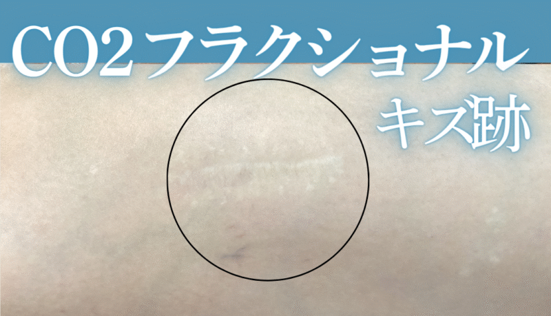 20代女性：キズ跡に対してCO2フラクショナルレーザー